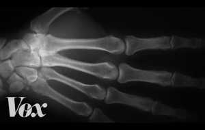 Cracking knuckles for 60 years and no arthritis 